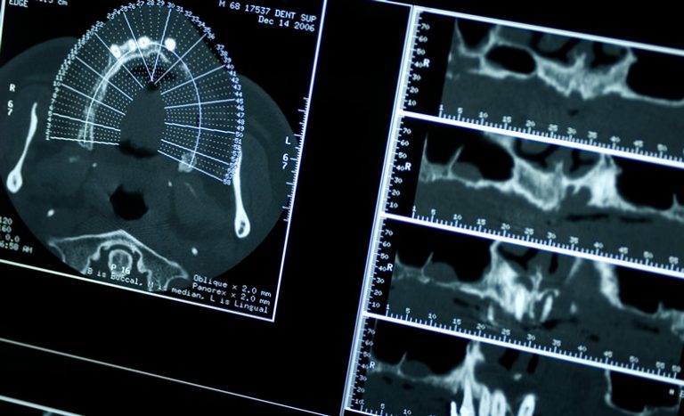 Clínica dental Chamberí Madrid Reconstrucciones Maxilares y Mandibulares
