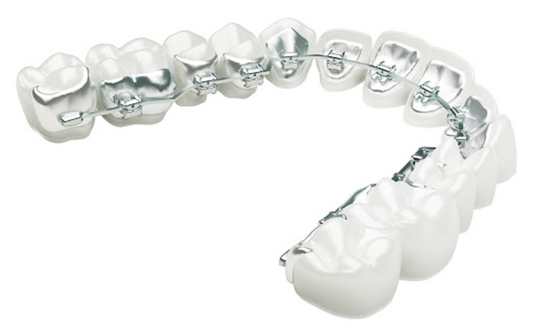 Clínica dental Chamberí Madrid Ortodoncia lingual